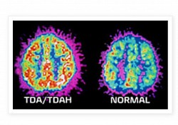 Cerveau TDA/H et cerveau Normal